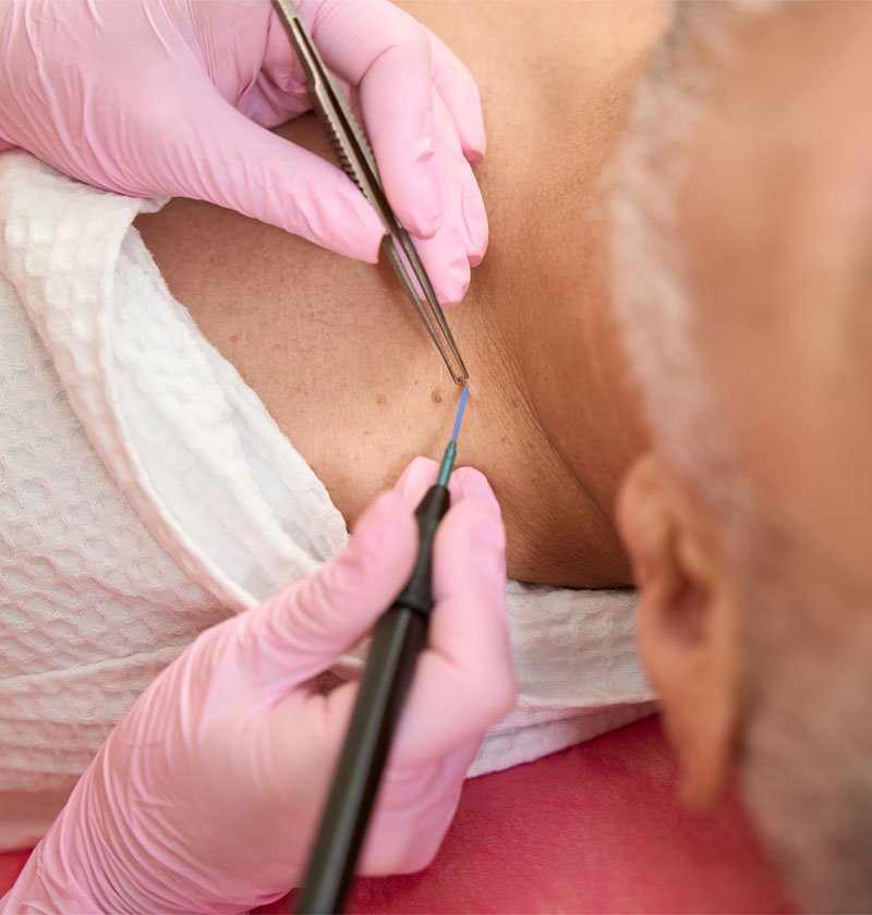 Skin Surgical Treatment