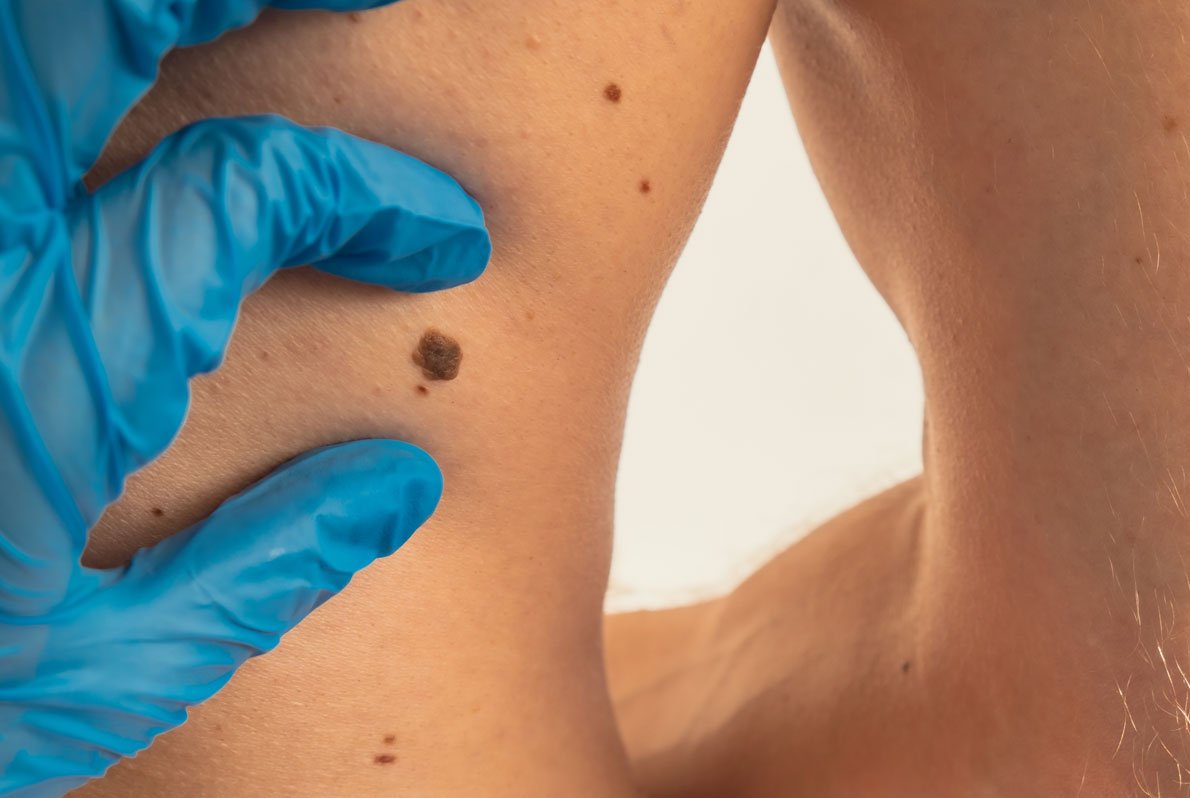 Melanoma Surgery